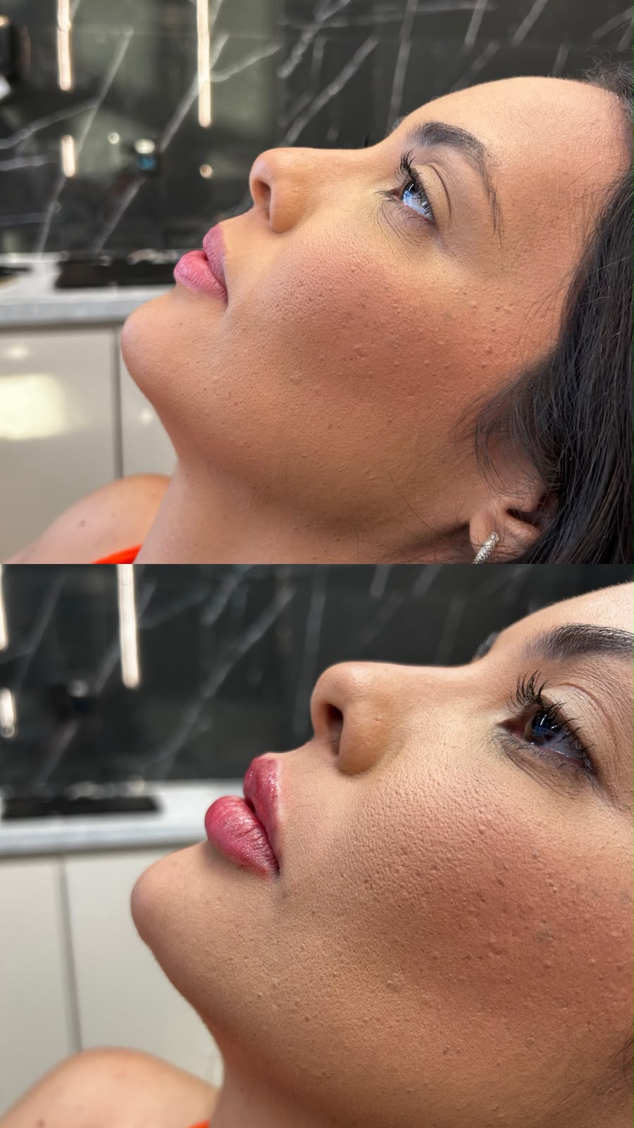Antes e depois de preenchimento bucal — caso 3