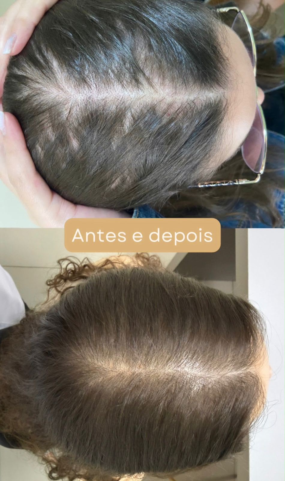 Antes e depois de tratamento capilar — caso 1