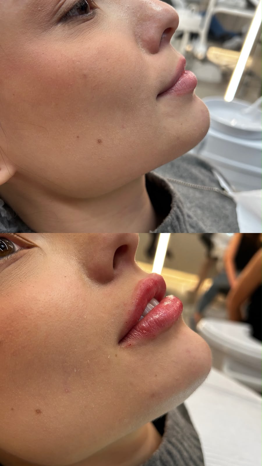 Antes e depois de preenchimento bucal — caso 5