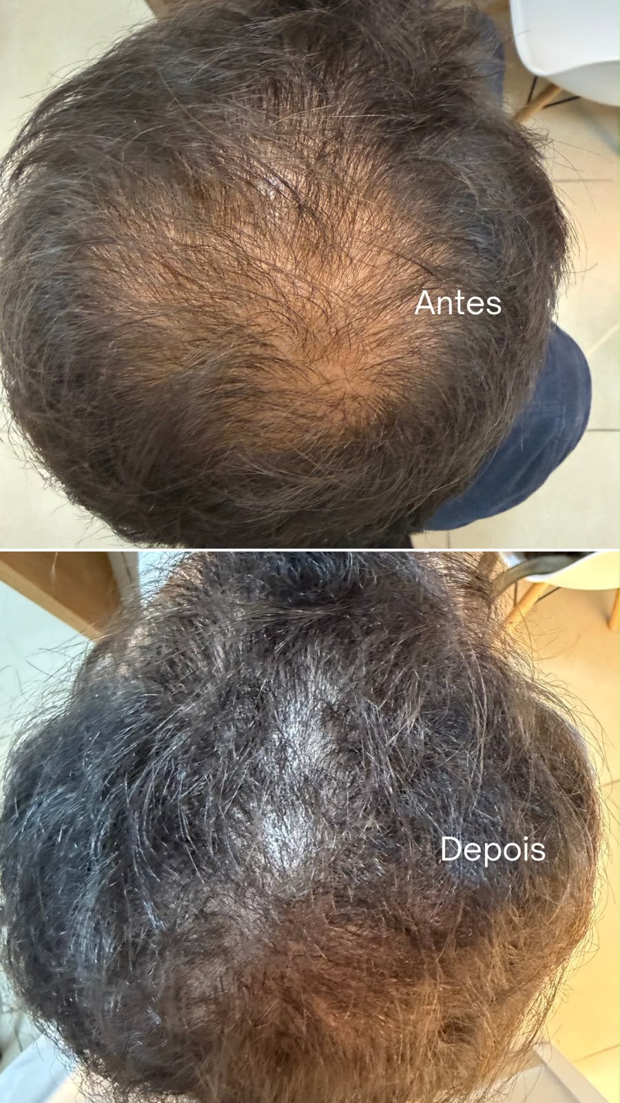 Antes e depois de tratamento capilar — caso 2