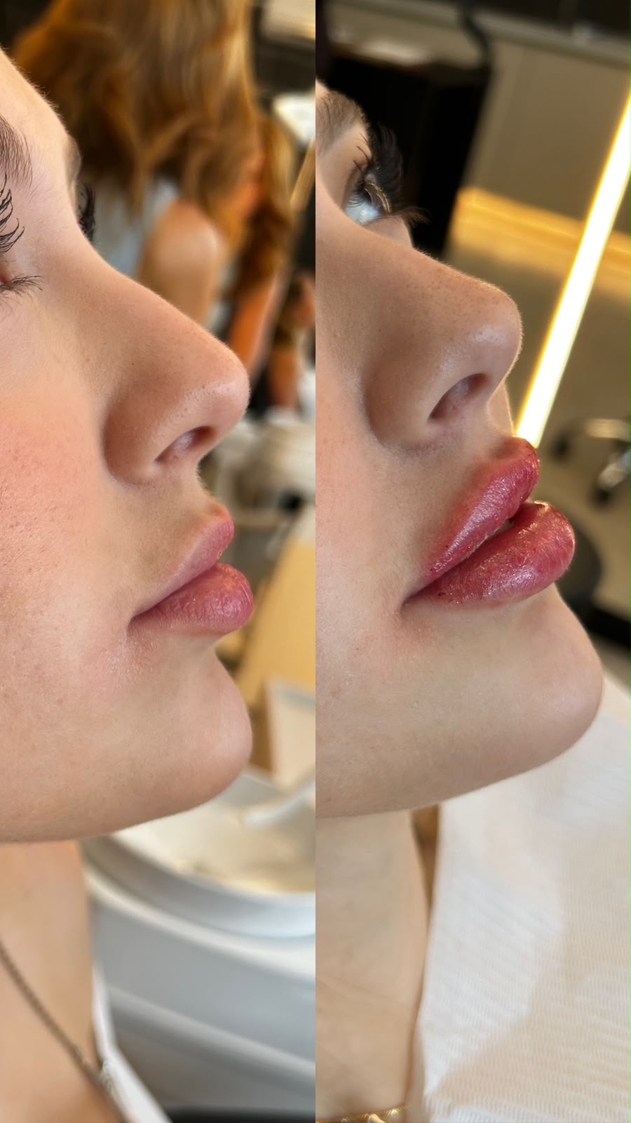 Antes e depois de preenchimento bucal — caso 4