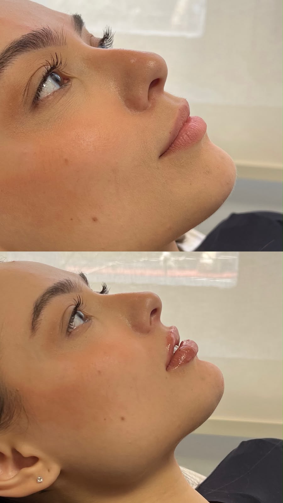 Antes e depois de preenchimento bucal — caso 2