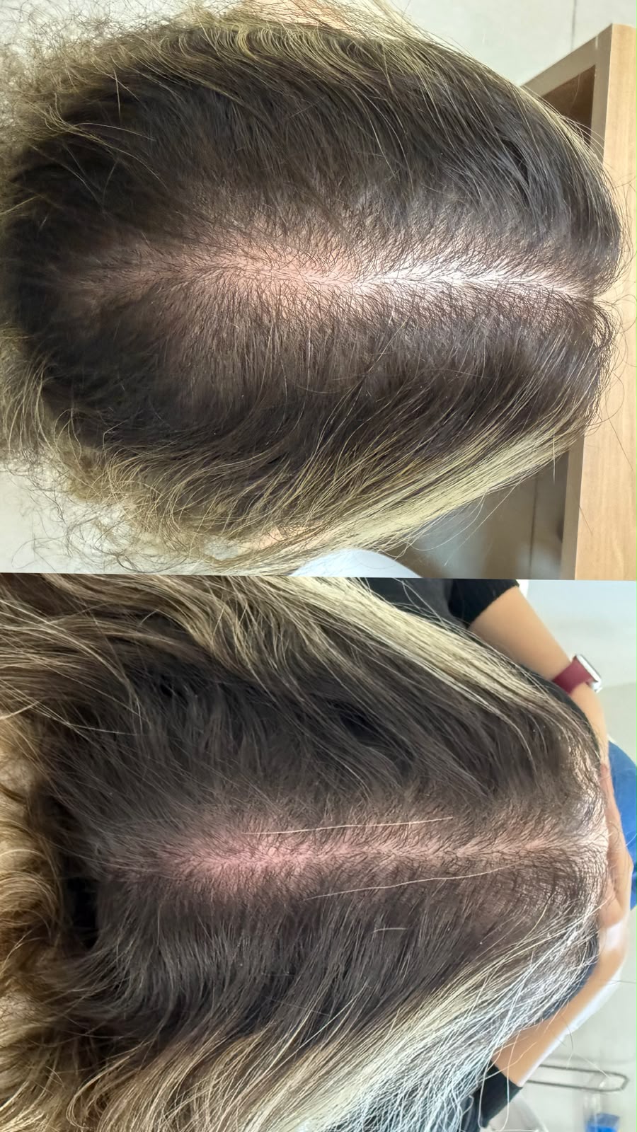 Antes e depois de tratamento capilar — caso 3