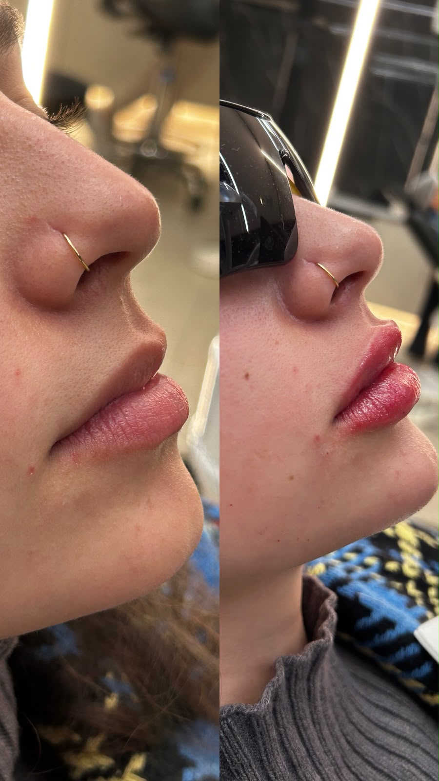 Antes e depois de preenchimento bucal — caso 1